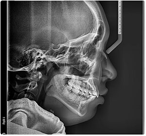 Cephalometric-Profile